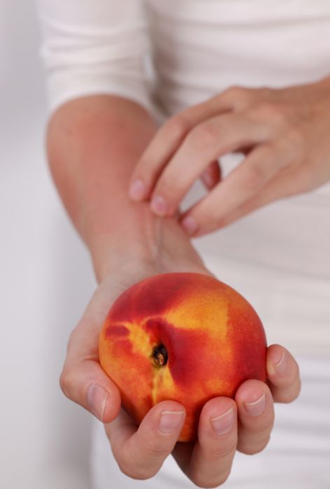 woman suffering from fruit allergy holding a peach. skin redness is visible